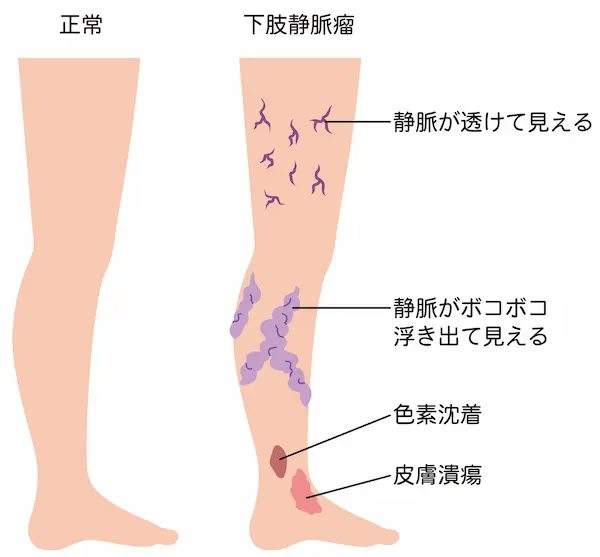 下肢静脈瘤の症状