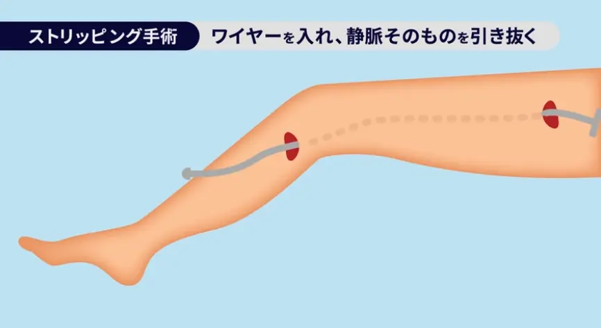 ストリッピング