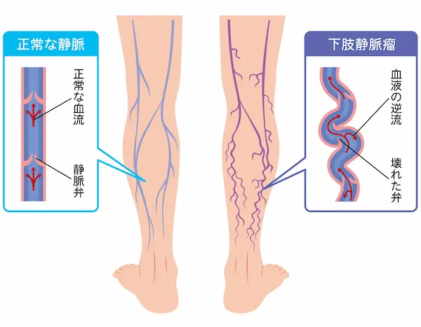 下肢静脈瘤の原因