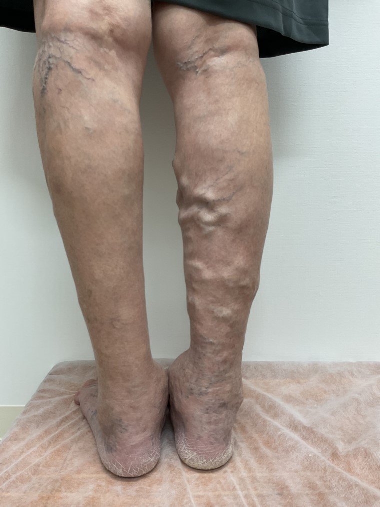 下肢静脈瘤の症例