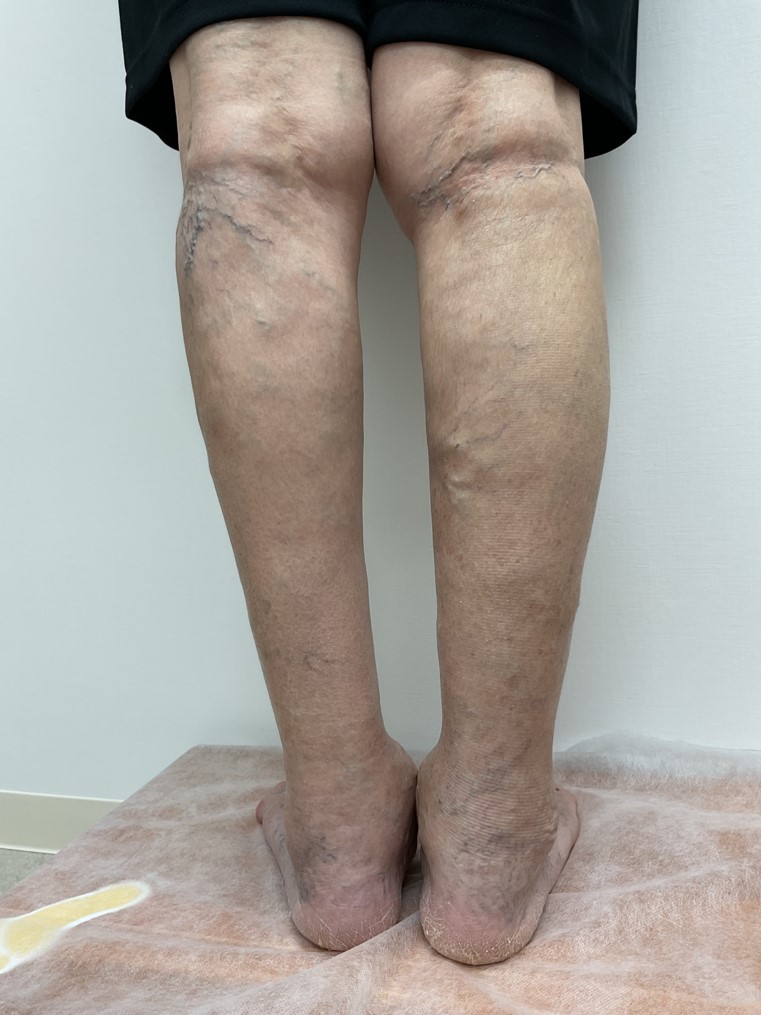 下肢静脈瘤の症例