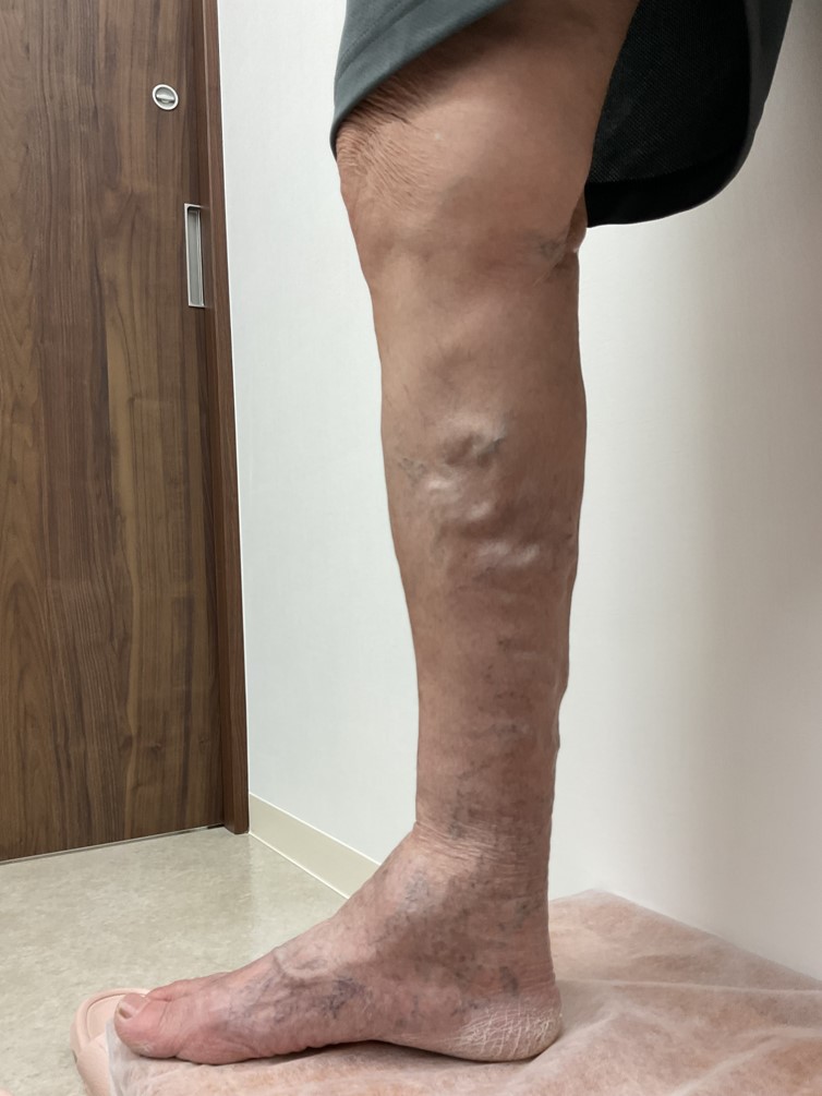 下肢静脈瘤の症例