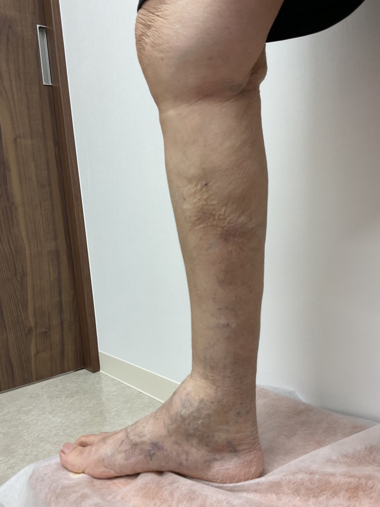 下肢静脈瘤の症例
