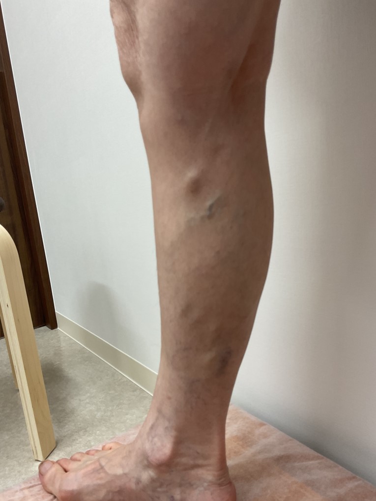 下肢静脈瘤の症例