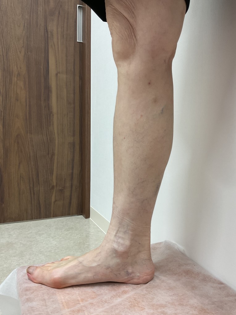 下肢静脈瘤の症例