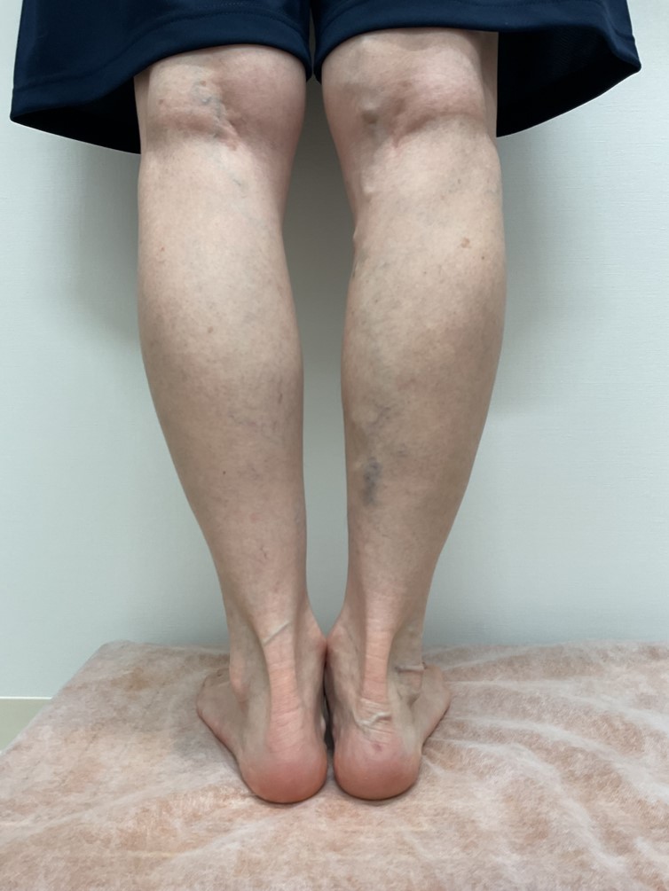 下肢静脈瘤の症例
