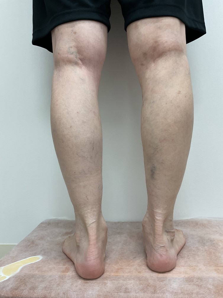 下肢静脈瘤の症例