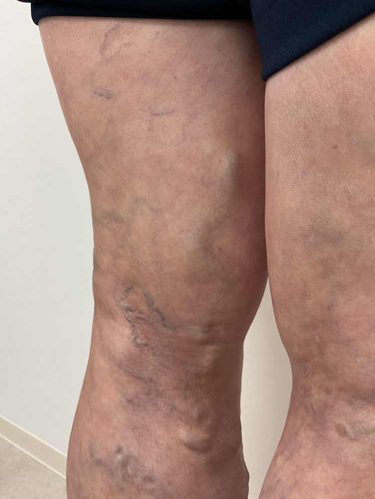 下肢静脈瘤の症例