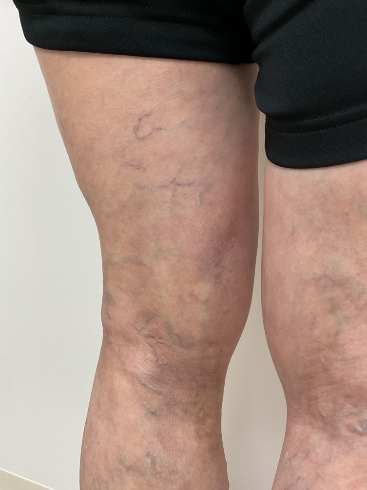 下肢静脈瘤の症例