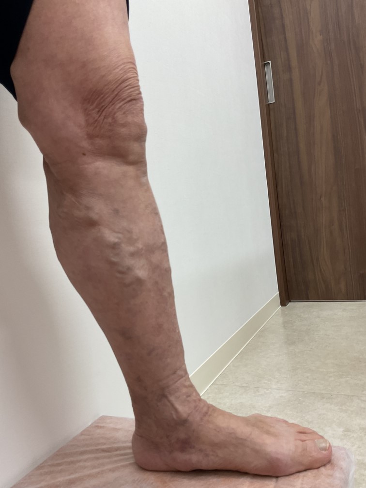 下肢静脈瘤の症例