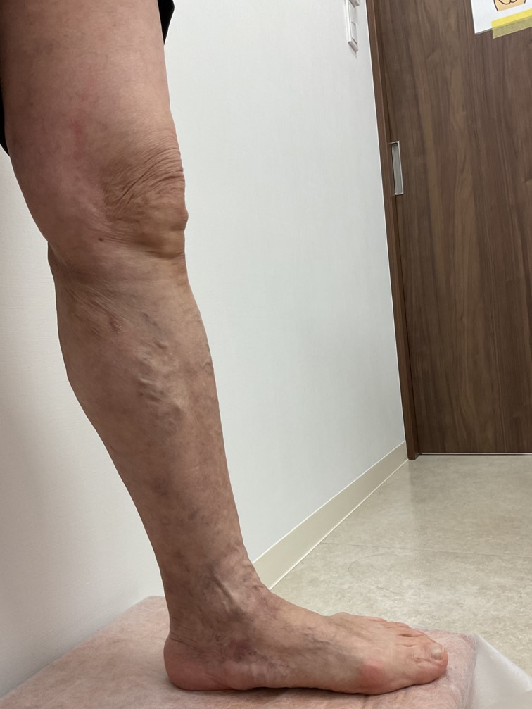 下肢静脈瘤の症例