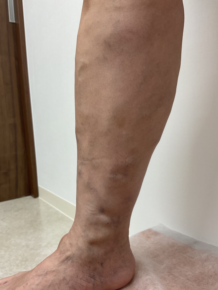 下肢静脈瘤の症例