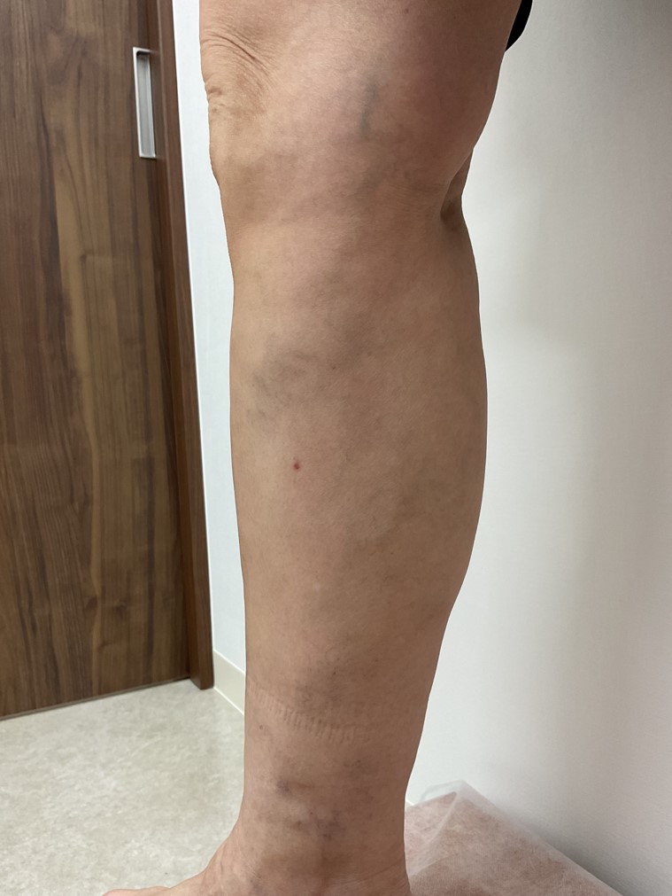 下肢静脈瘤の症例