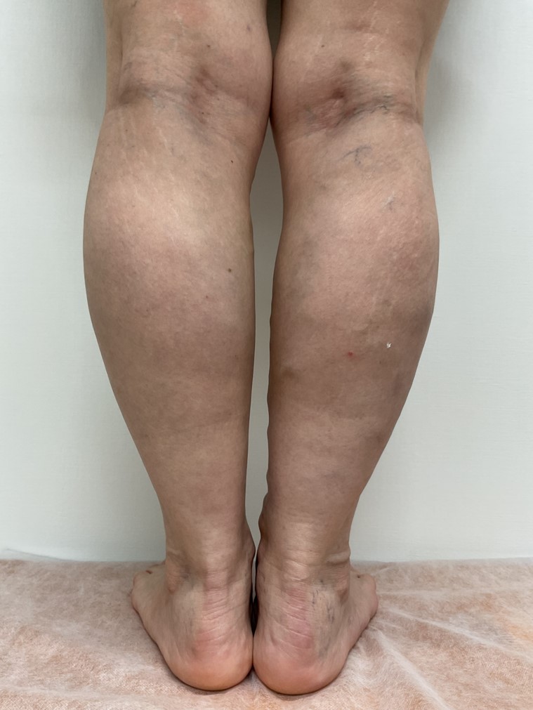 下肢静脈瘤の症例
