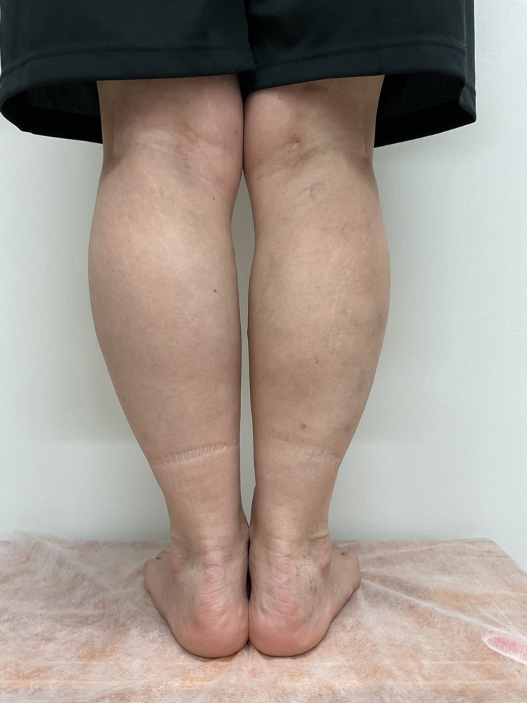 下肢静脈瘤の症例