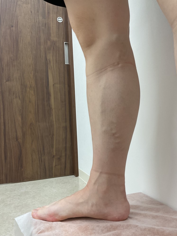 下肢静脈瘤の症例