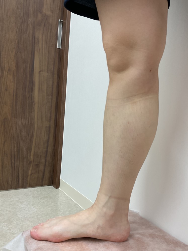下肢静脈瘤の症例