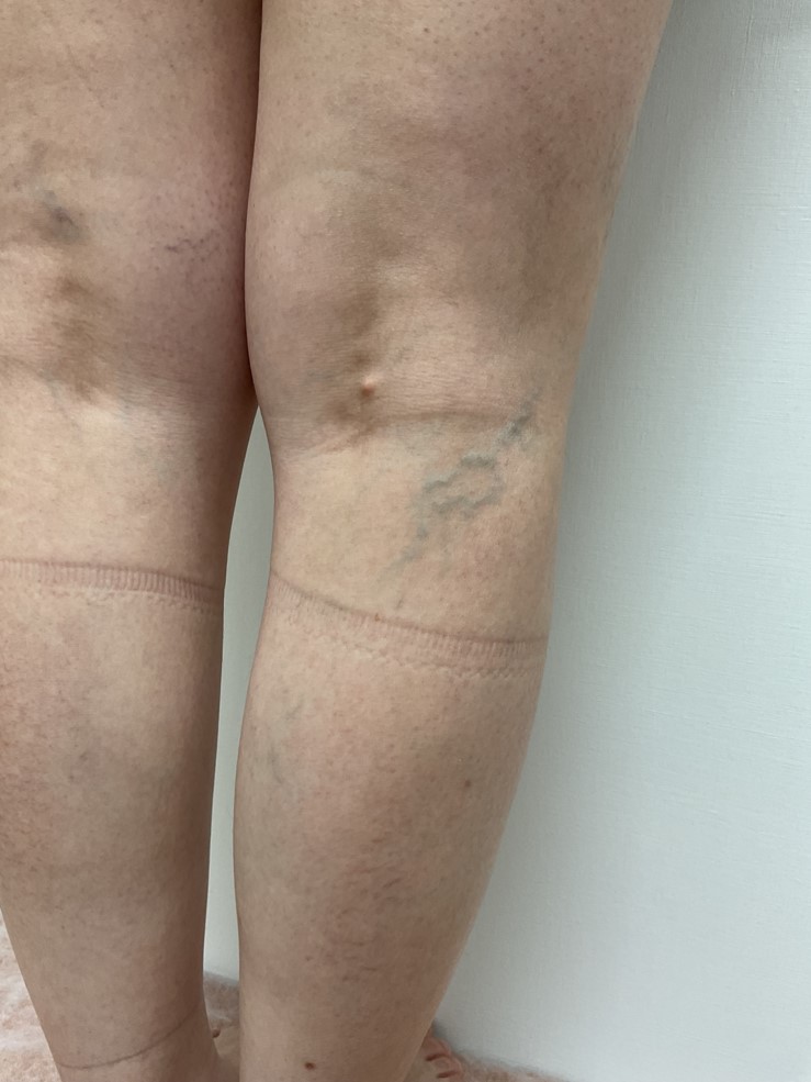 下肢静脈瘤の症例
