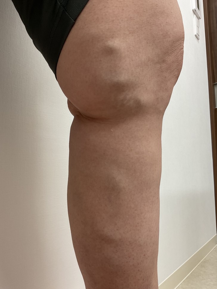 下肢静脈瘤の症例