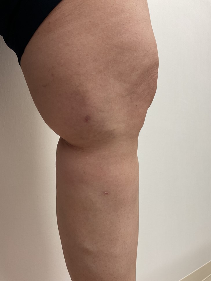 下肢静脈瘤の症例