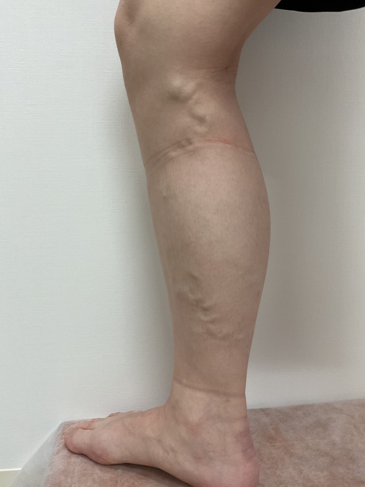下肢静脈瘤の症例