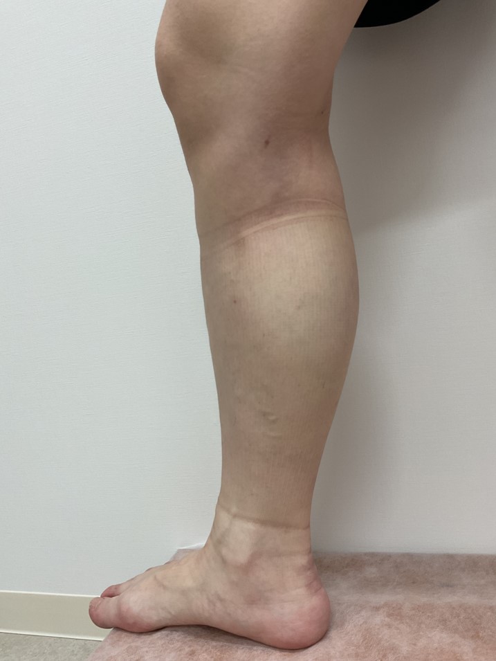 下肢静脈瘤の症例