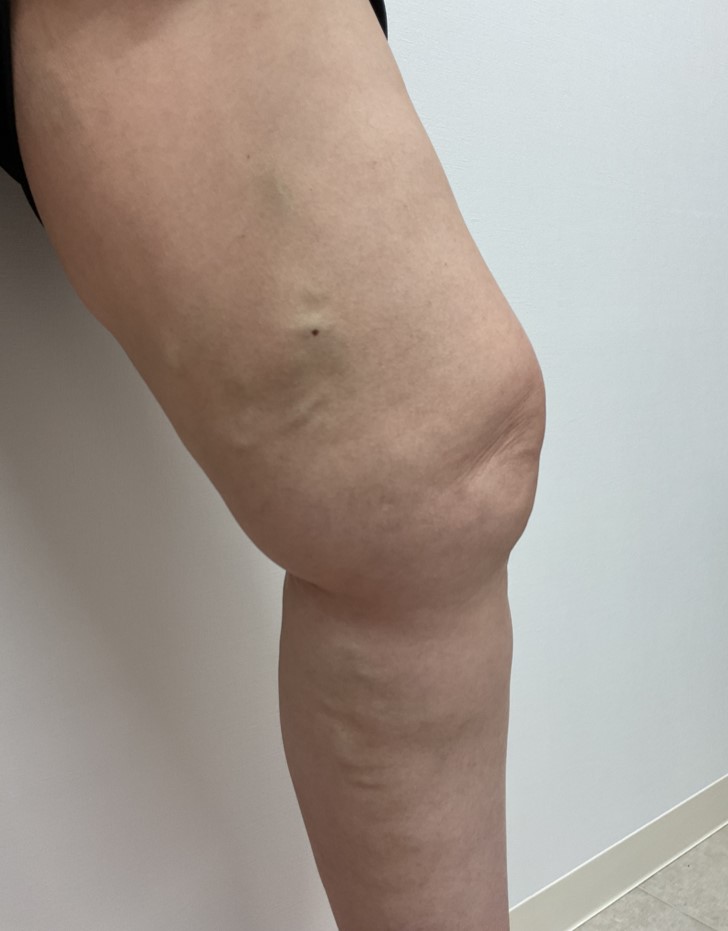 下肢静脈瘤の症例