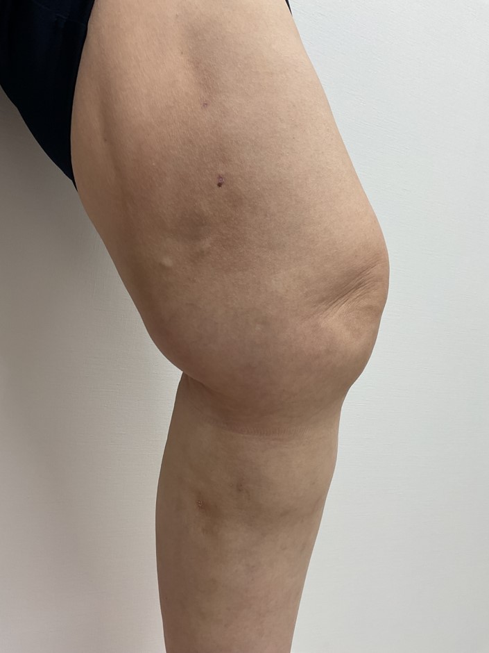 下肢静脈瘤の症例