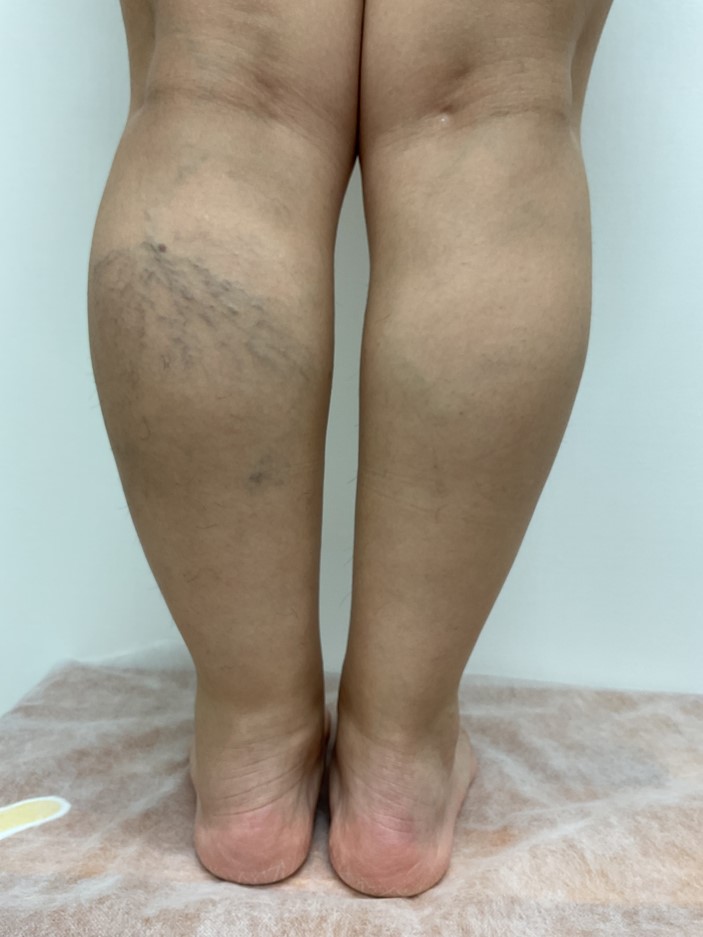下肢静脈瘤の症例