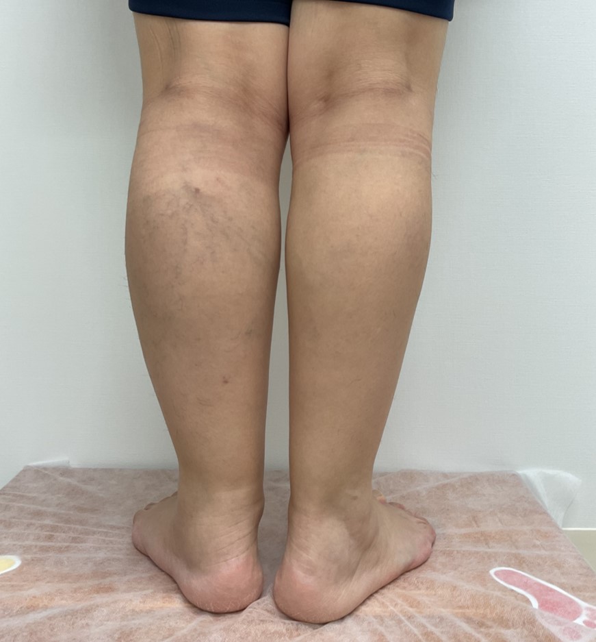 下肢静脈瘤の症例