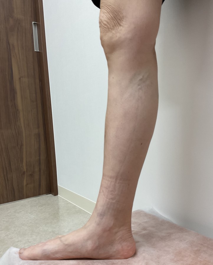 下肢静脈瘤の症例