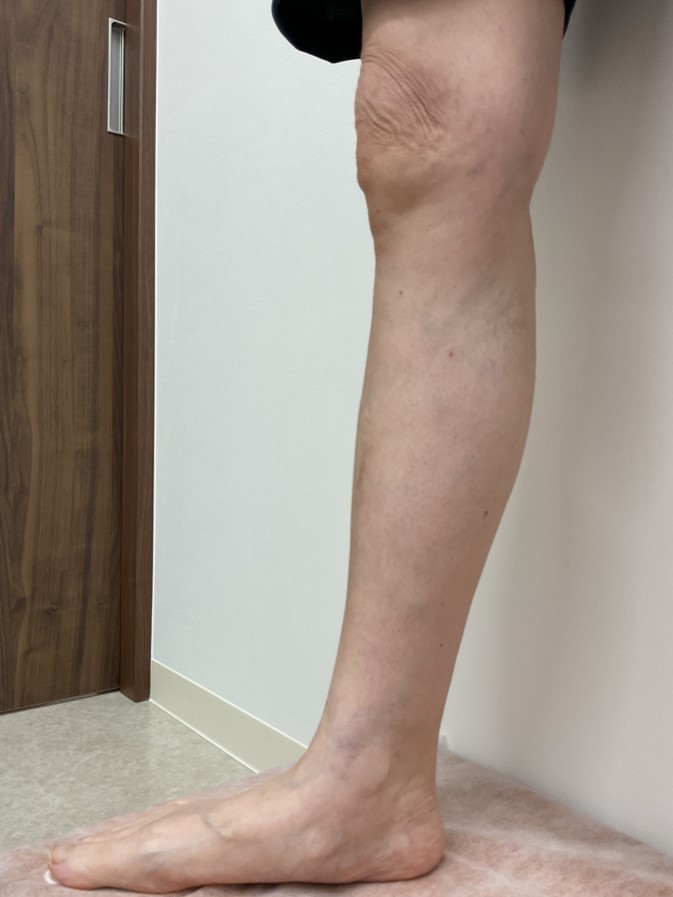 下肢静脈瘤の症例