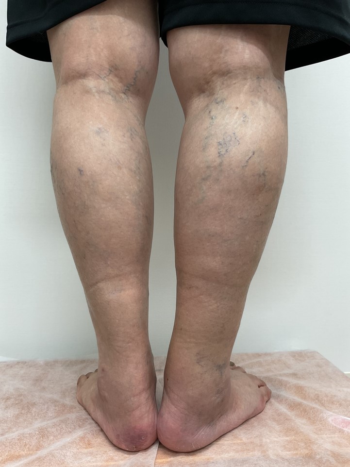 下肢静脈瘤の症例