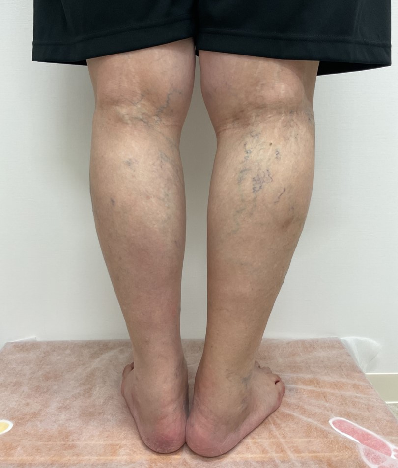 下肢静脈瘤の症例