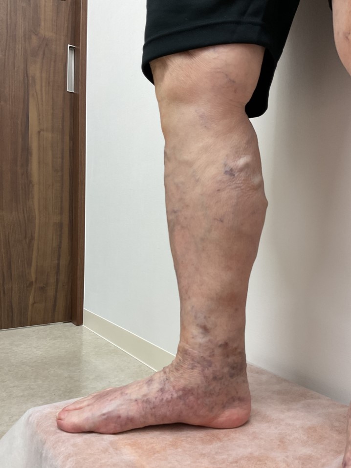 下肢静脈瘤の症例