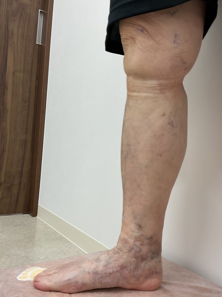 下肢静脈瘤の症例