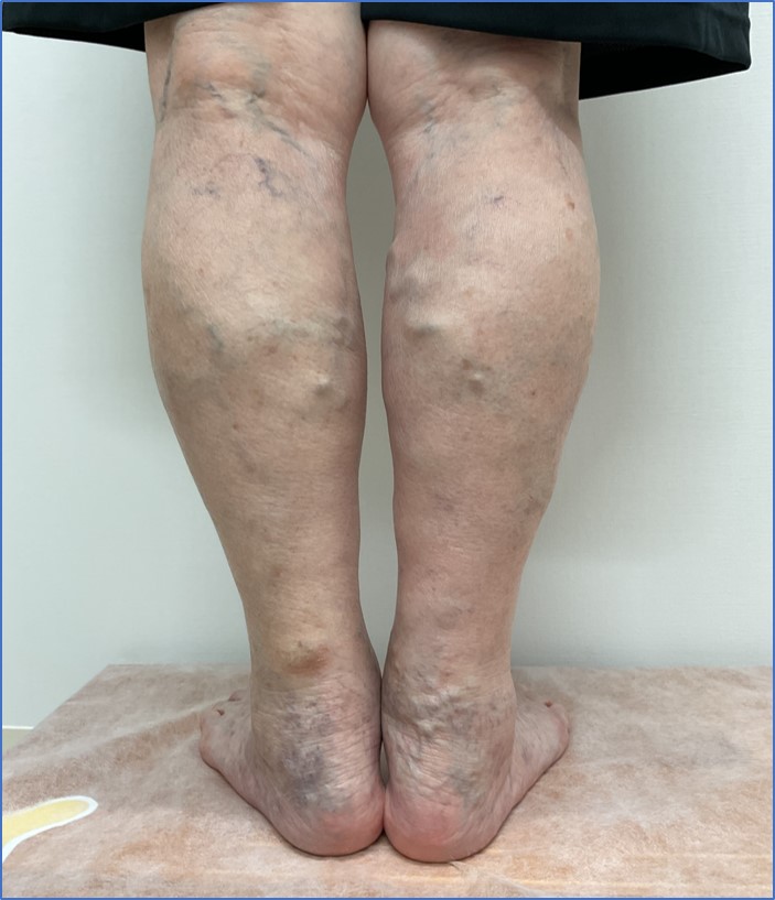 下肢静脈瘤の症例