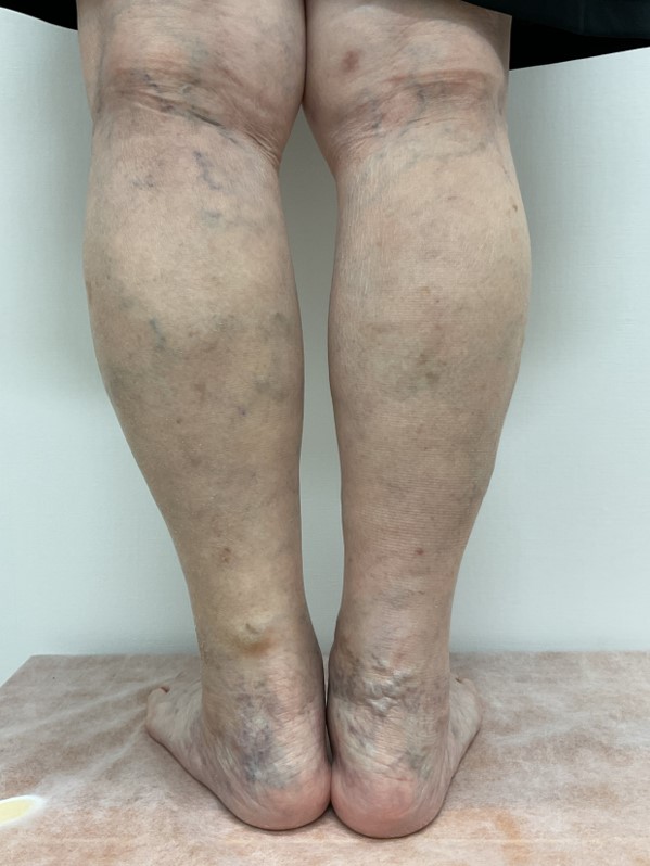 下肢静脈瘤の症例
