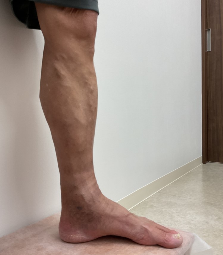 下肢静脈瘤の症例