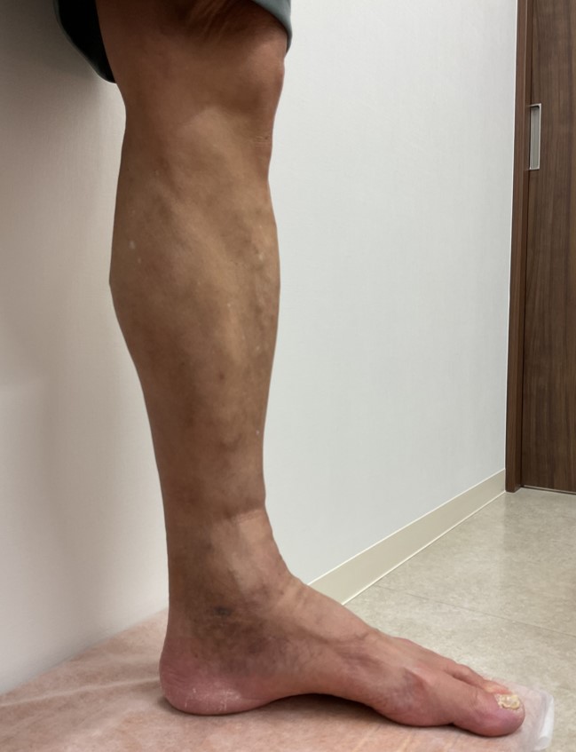 下肢静脈瘤の症例