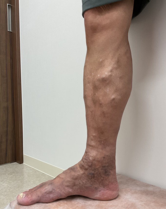 下肢静脈瘤の症例