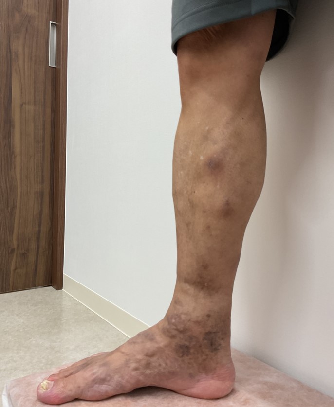 下肢静脈瘤の症例
