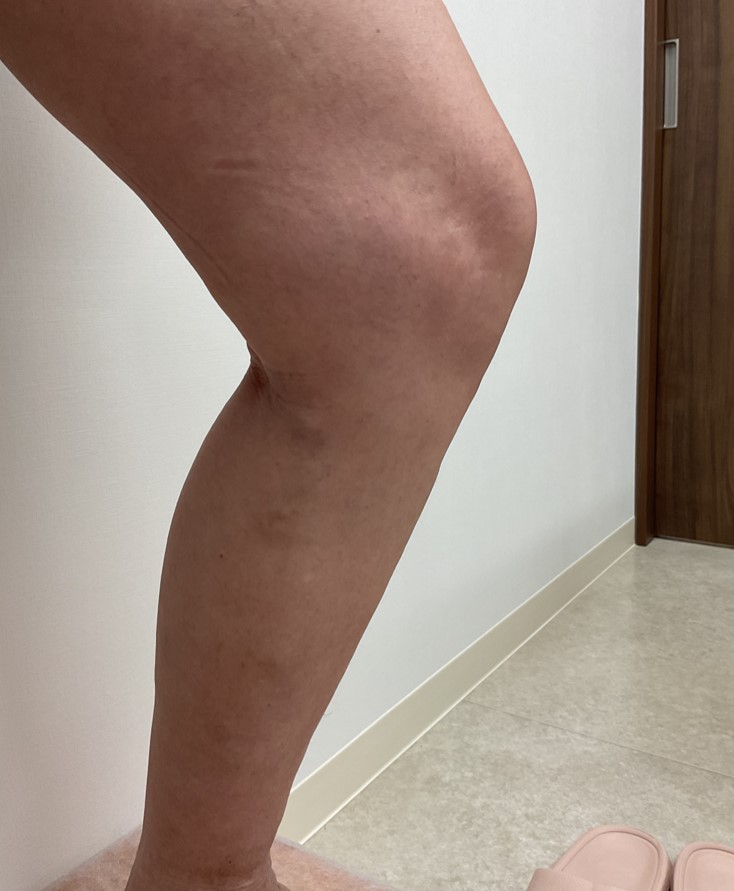 下肢静脈瘤の症例