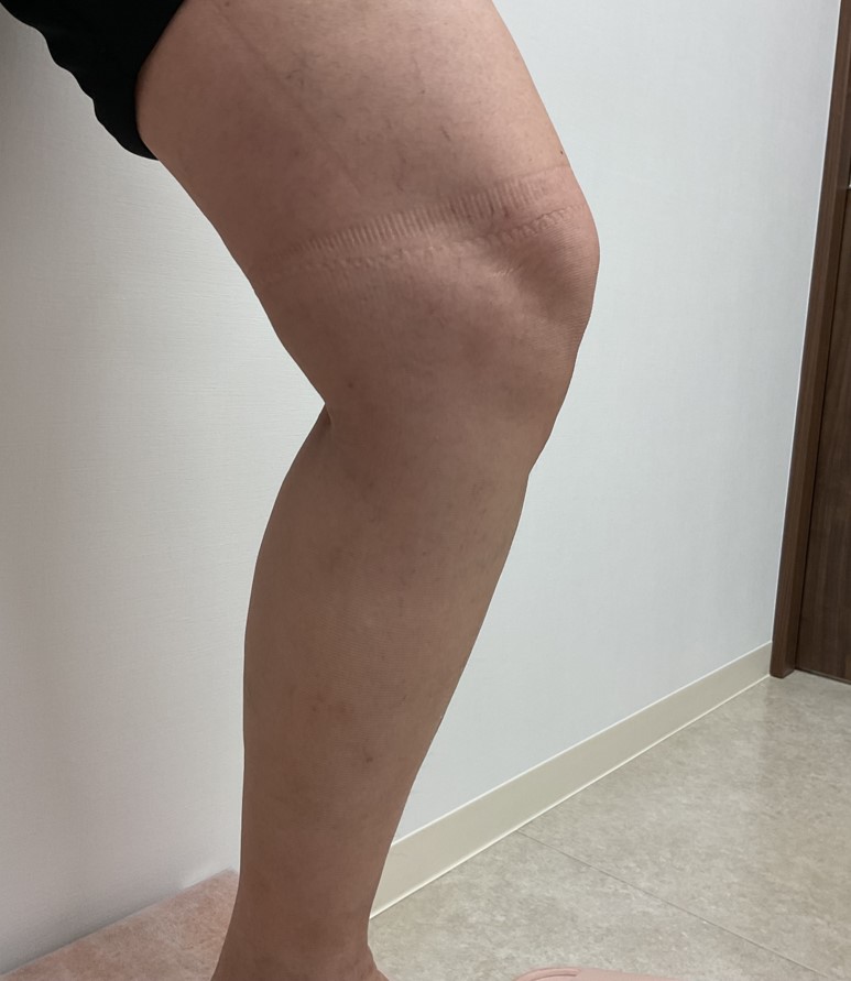 下肢静脈瘤の症例