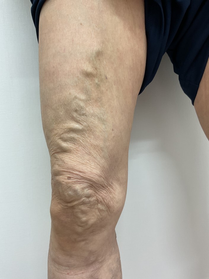 下肢静脈瘤の症例