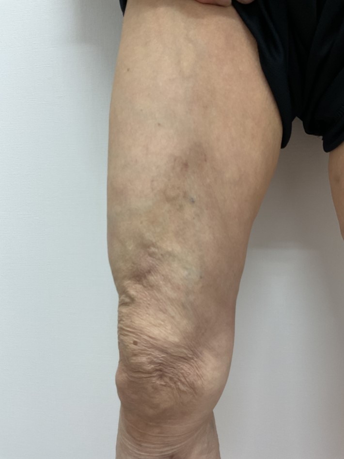下肢静脈瘤の症例