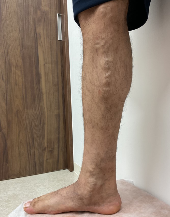 下肢静脈瘤の症例