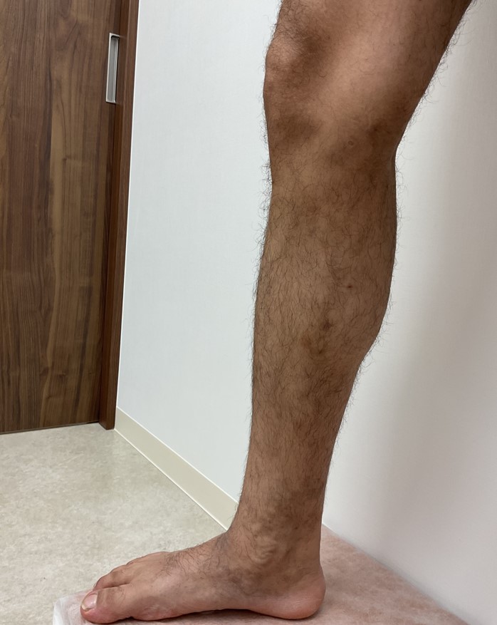 下肢静脈瘤の症例