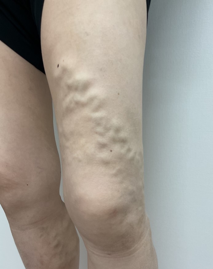 下肢静脈瘤の症例