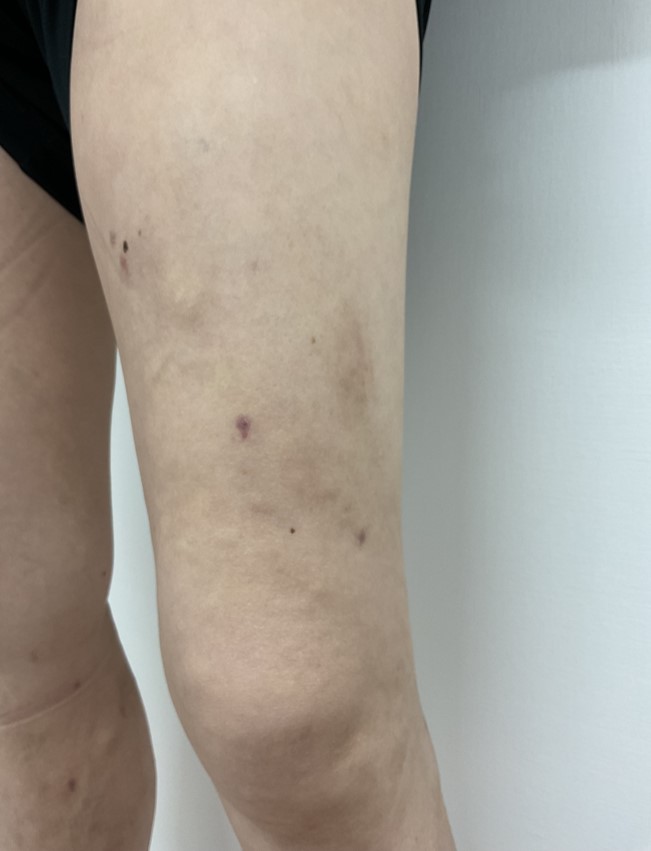 下肢静脈瘤の症例